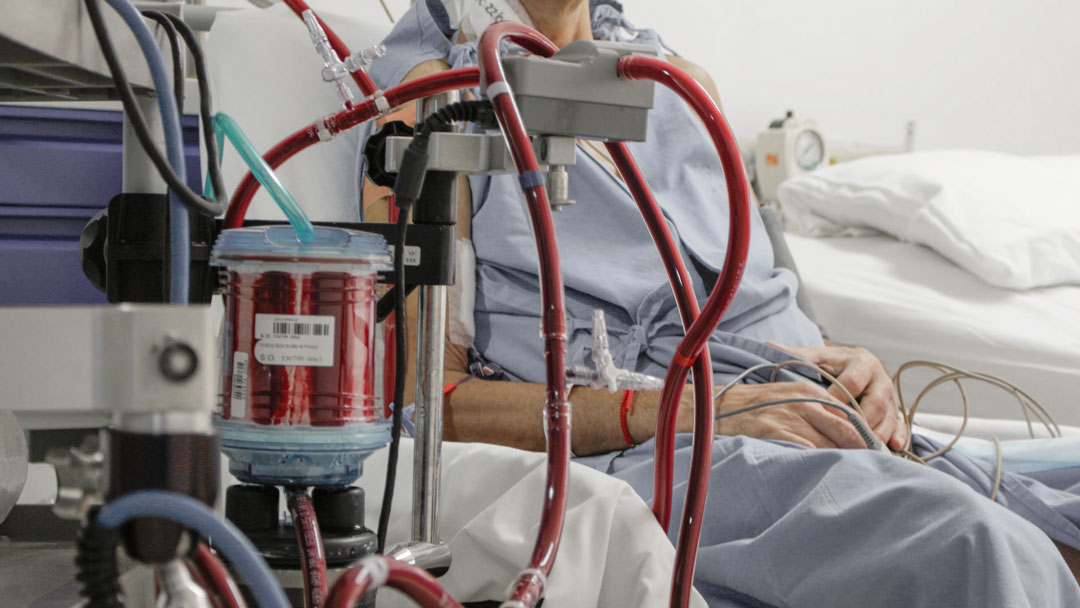 اکسیژن‌رسانی غشایی با دستگاه ECMO برای نارسایی تنفسی و قلبی